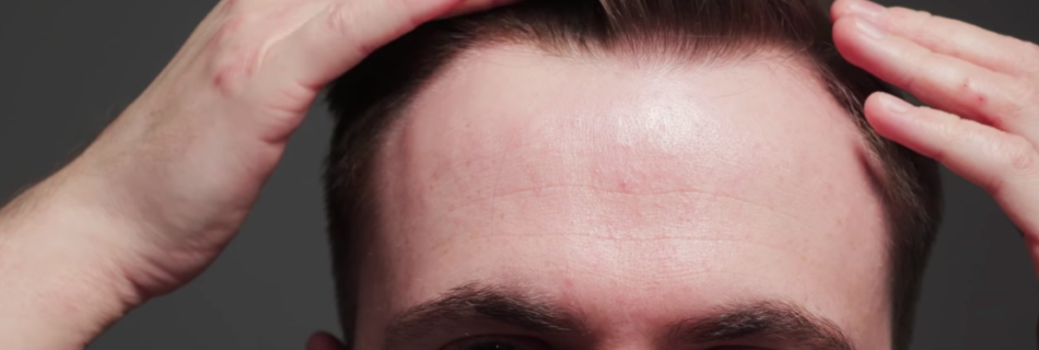Hairline Tattoos as a Solution to Correct Receding Hairlines