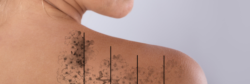 Tattoo Removal or Tattoo Cover Up - 6 Things You Should Know